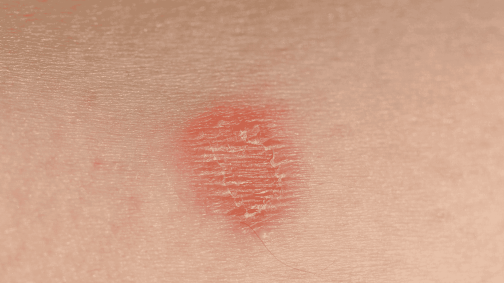 Micoses de Pele | Dra. Camila Laranjo | Dermatologista