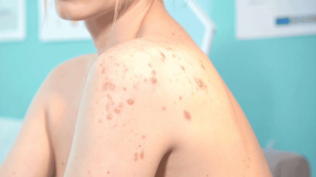 Cicatrizes de Acne | Dra. Camila Laranjo | Dermatologista