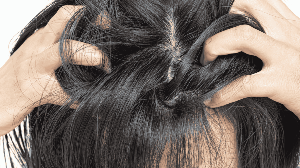 Dermatite Seborreica | Dra. Camila Laranjo | Dermatologista