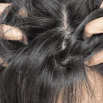Dermatite Seborreica | Dra. Camila Laranjo | Dermatologista