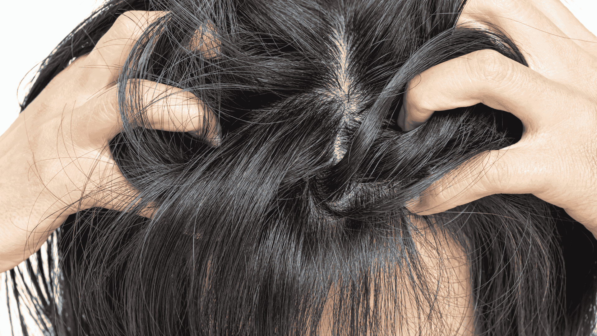 Dermatite Seborreica | Dra. Camila Laranjo | Dermatologista