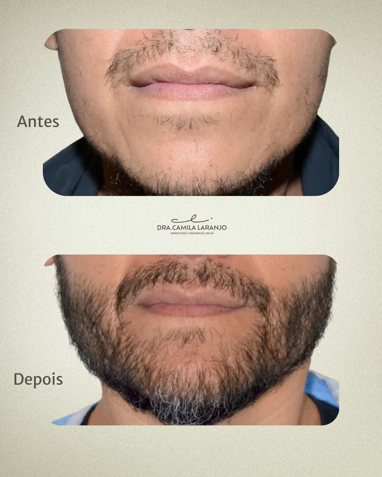 Resultado Transplante Capilar - Caso 2