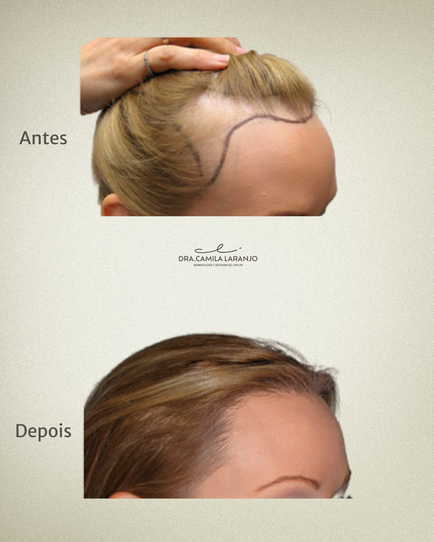 Resultado Transplante Capilar - Caso 4