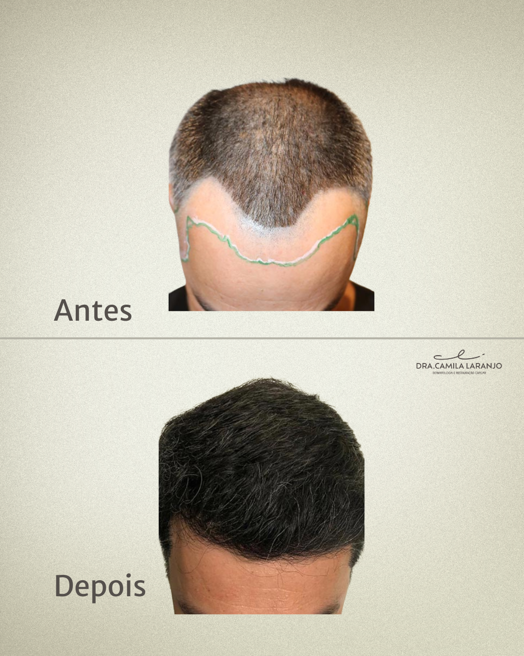 Resultado Transplante Capilar - Caso 1